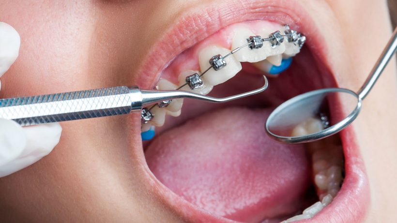 Diş Teli Nedir, Ne İşe Yarar?